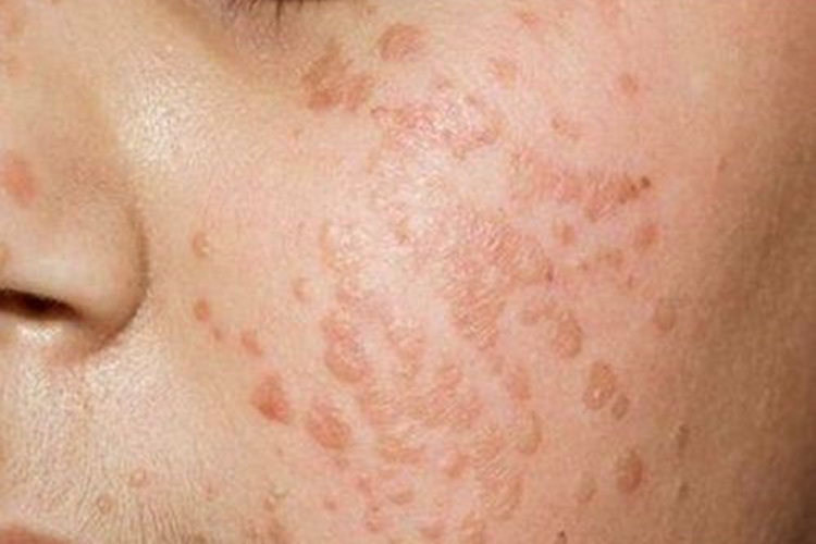 脸上为什么会长扁平疣