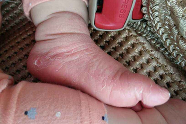 干燥型婴儿湿疹脚部脱皮图