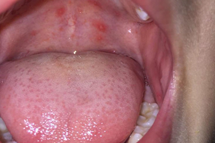 疱疹性咽峡炎咽峡血点图