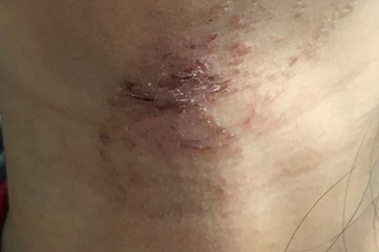 亚急性湿疹前颈结痂脱屑图