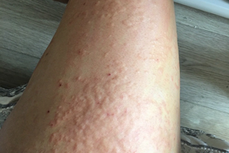 痒疹型多形性日光疹大腿症状图