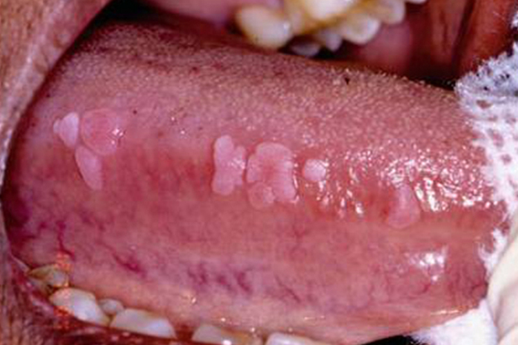口腔鳞状上皮增生有斑块图 口腔鳞状上皮增生有斑块图