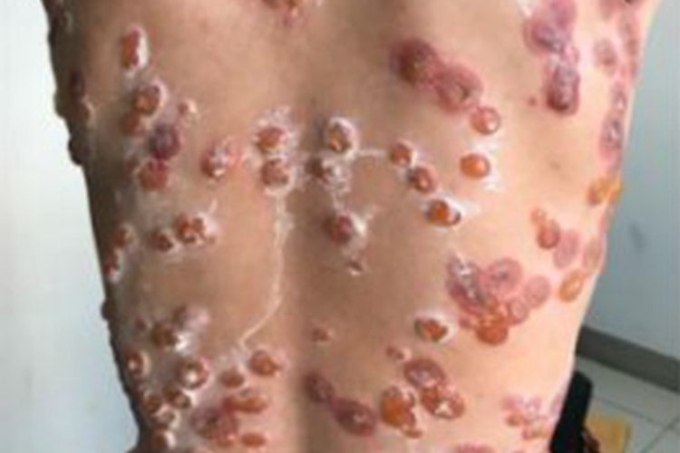 线状lgA大疱性皮病背部大疱图 线状lgA大疱性皮病背部大疱图