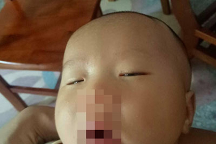 慢性新生儿核黄疸症状图