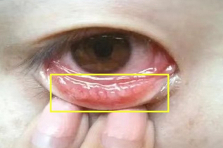 进行期沙眼眼睑小疙瘩图 进行期沙眼眼睑小疙瘩图