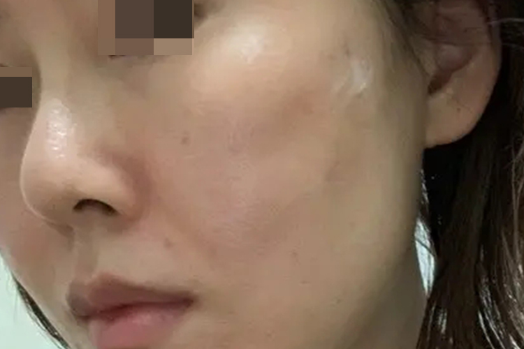 线雕失败皮肤凹凸不平图