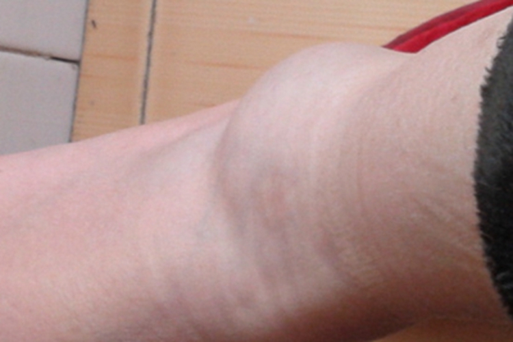 踝扭伤脚踝肿胀有个大包图