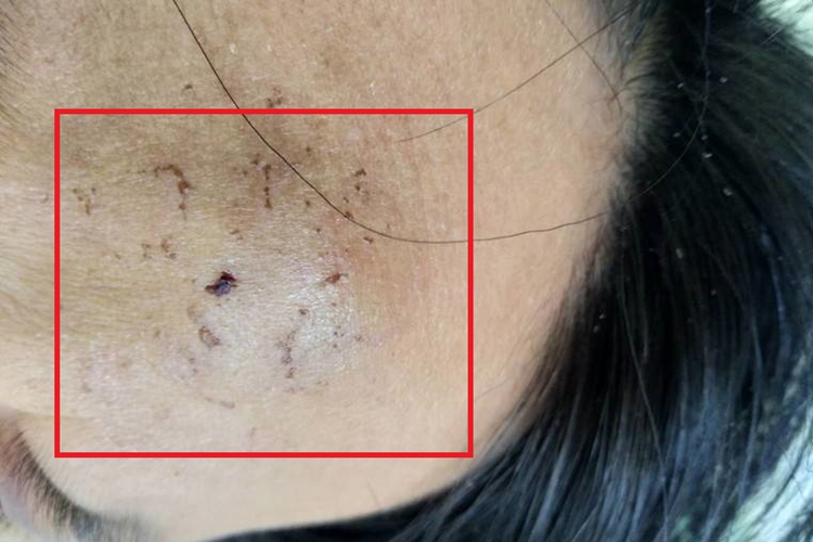 头皮血肿前额肿图