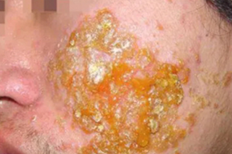 艾滋病期面部症状图