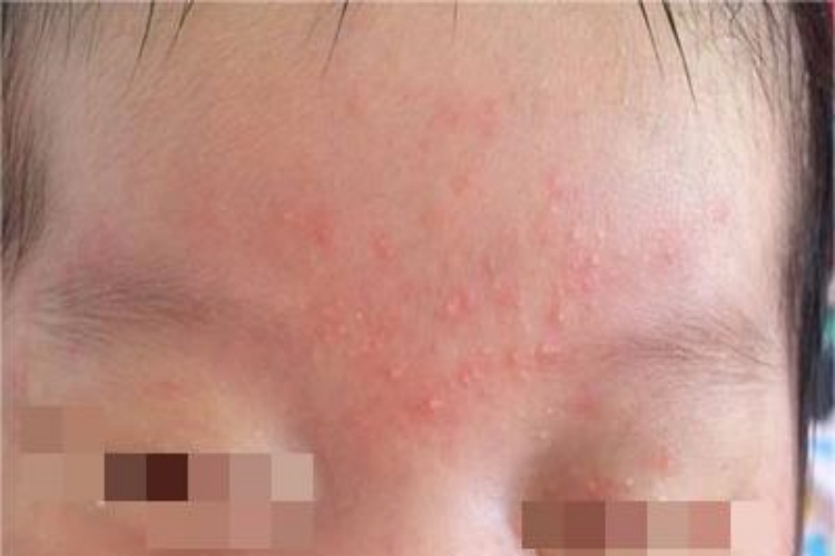 奶癣额头长了好多小颗粒图 奶癣额头长了好多小颗粒图