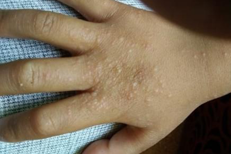 苔藓样念珠状疹手背小疙瘩图