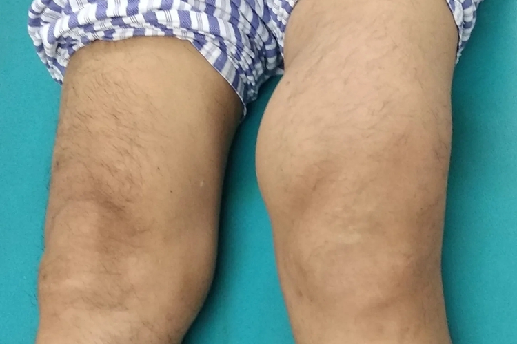 脂肪瘤图 脂肪瘤图