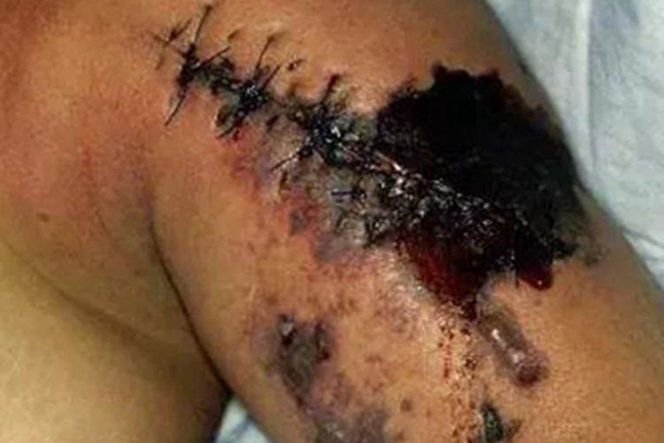 气性坏疽皮肤发黑图 气性坏疽皮肤发黑图