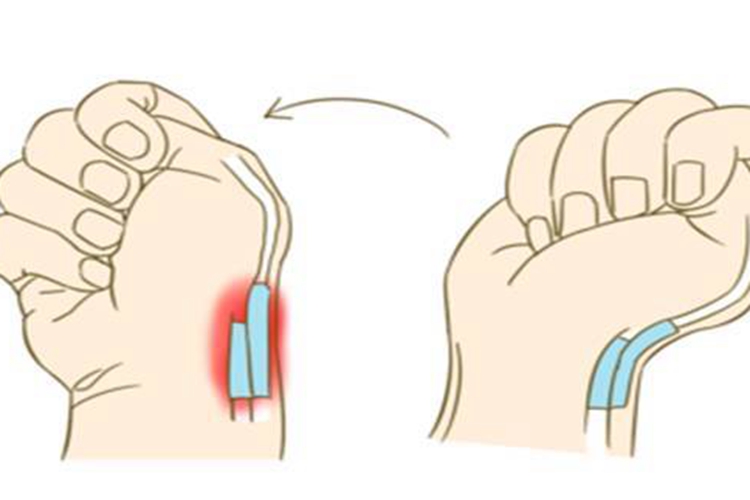 腱鞘炎手指疼痛图
