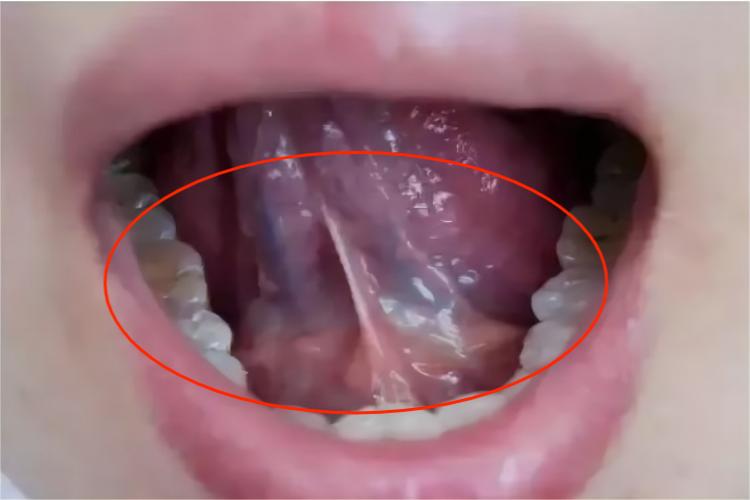 舌下间隙感染位置图