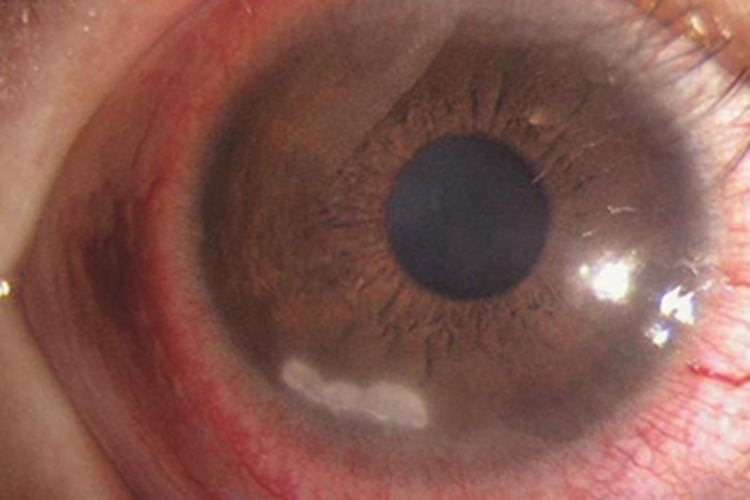 细菌性角膜炎眼球溃疡图