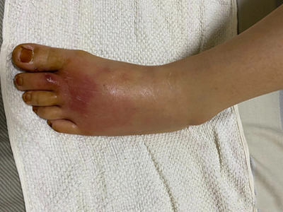 急性网状淋巴管炎的症状和图片 - 有来医生