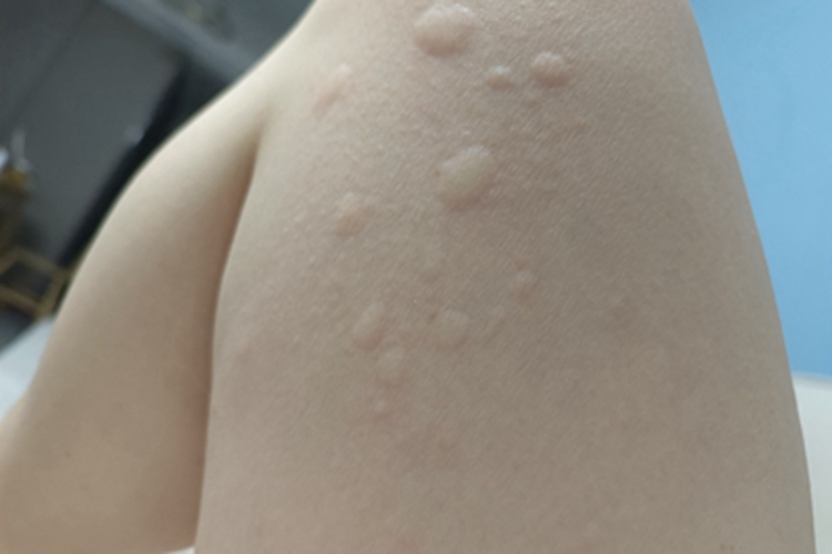 急性自发性荨麻疹大腿疙瘩图