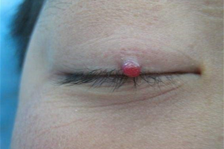 肉芽肿型血管瘤眼睑症状图