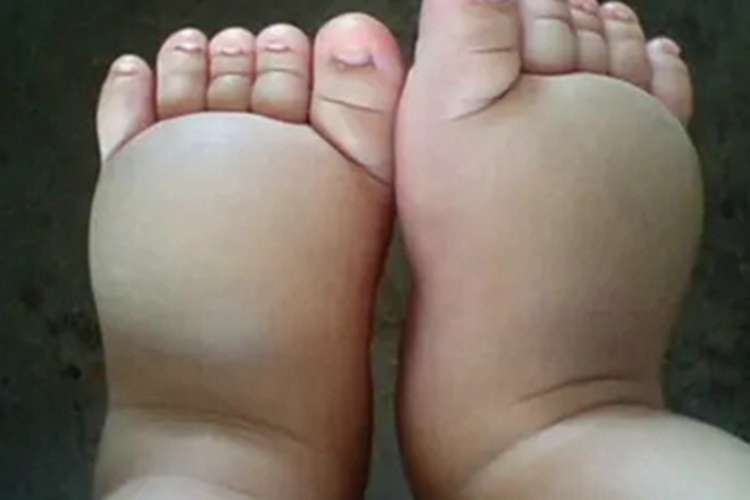 酪氨酸血症Ⅰ型硬块图