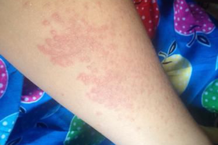 轻微紫外线过敏图