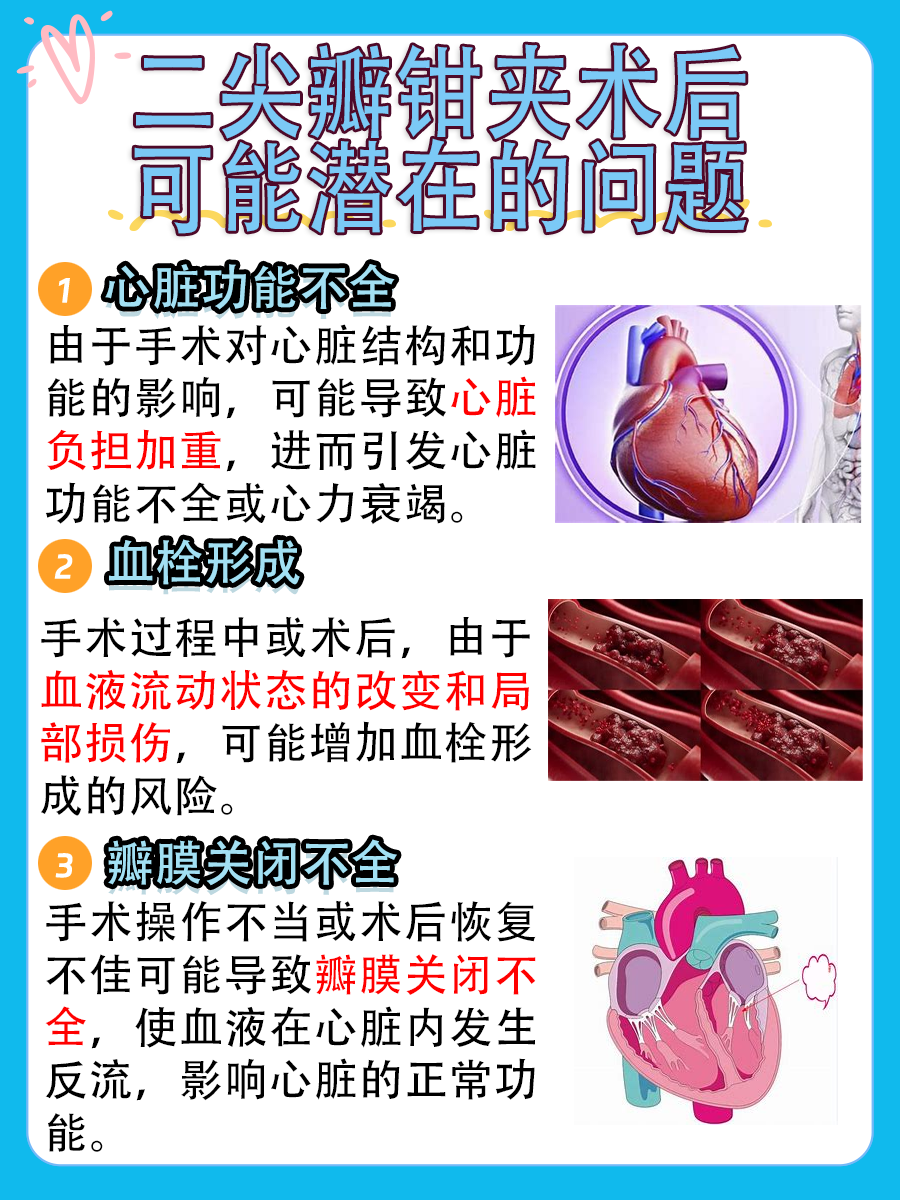 二尖瓣钳夹术后，能维持多久？