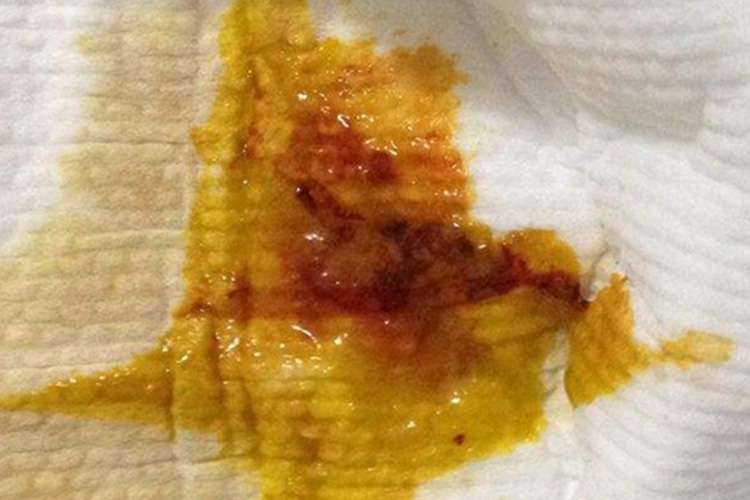 粪便有黏液和血丝图