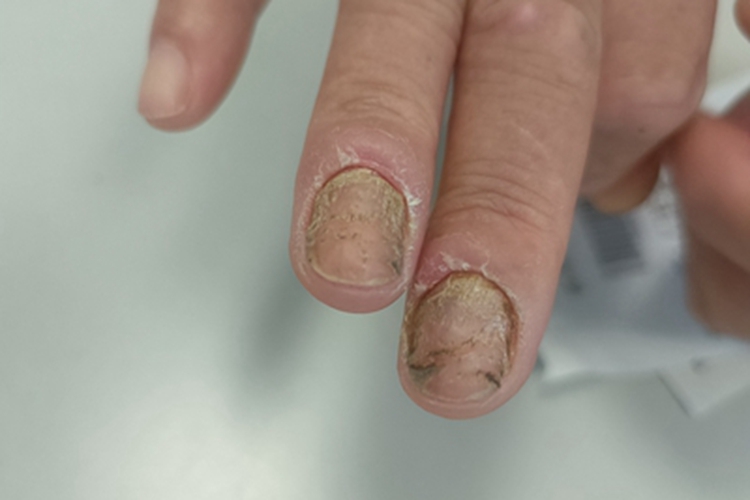 甲真菌病手指甲裂纹图 甲真菌病手指甲裂纹图