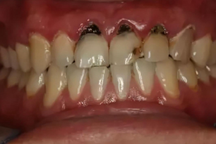 酸蚀症牙齿根部有黑斑图