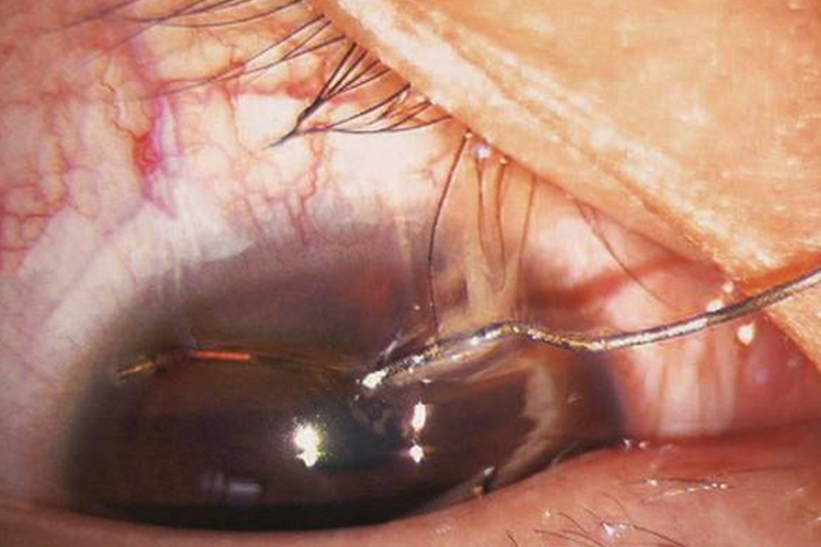 小孩角膜挫伤图