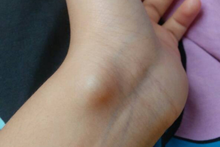 腱鞘巨细胞瘤手腕肿块图