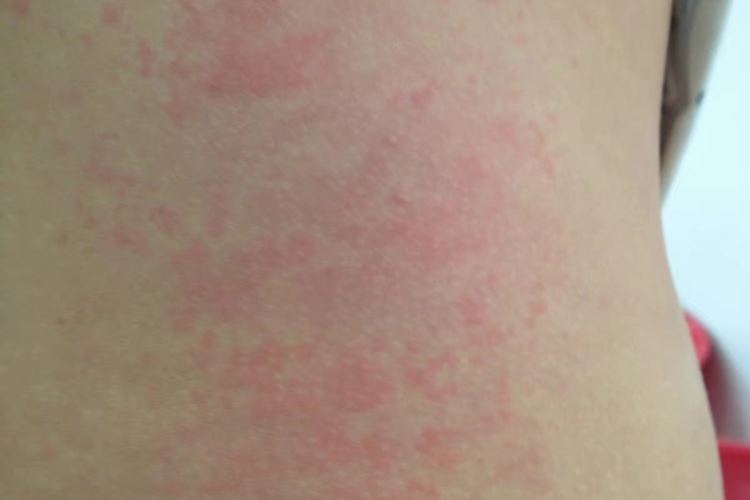 麻疹型药疹腰部症状图 麻疹型药疹腰部症状图