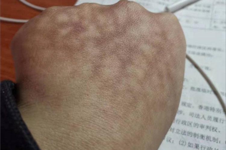 热激红斑手背红斑图