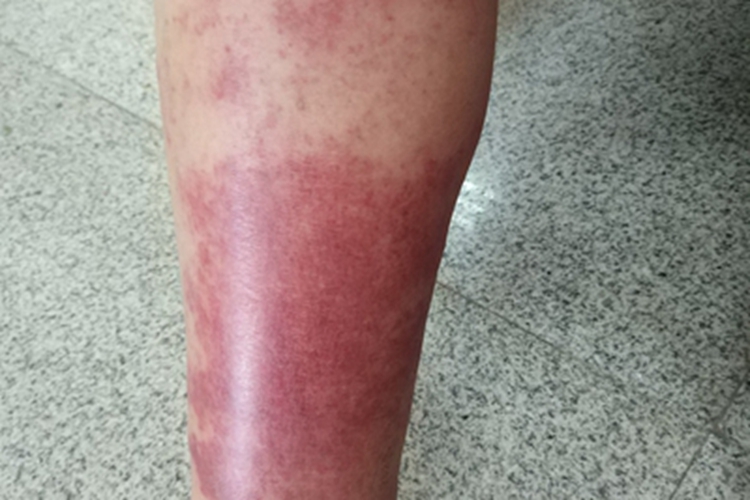 一氧化碳中毒小腿症状图