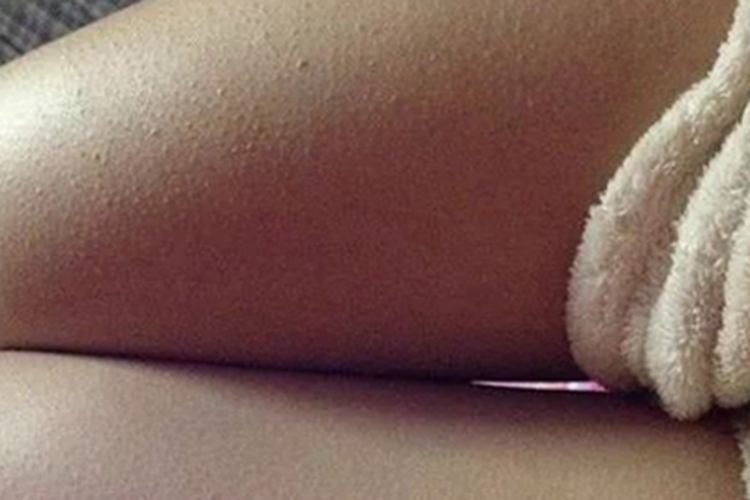 毛囊角化病大腿上有密集小疙瘩图