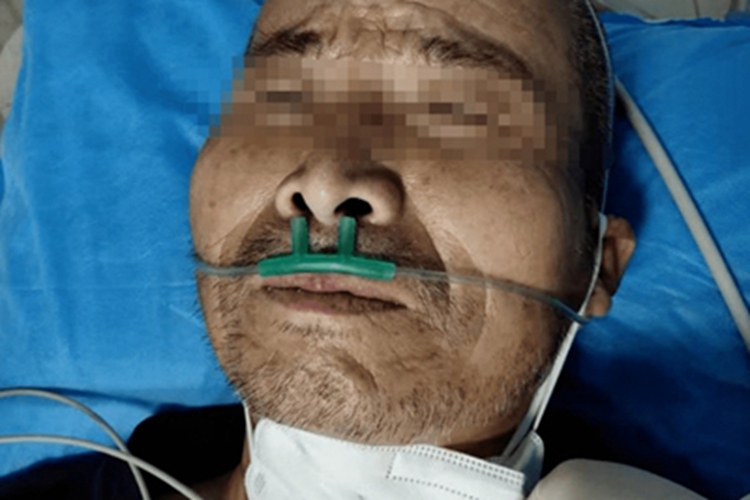 破伤风苦笑面容图 破伤风苦笑面容图