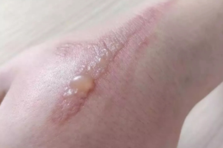 甲虫皮炎手背透明水疱图