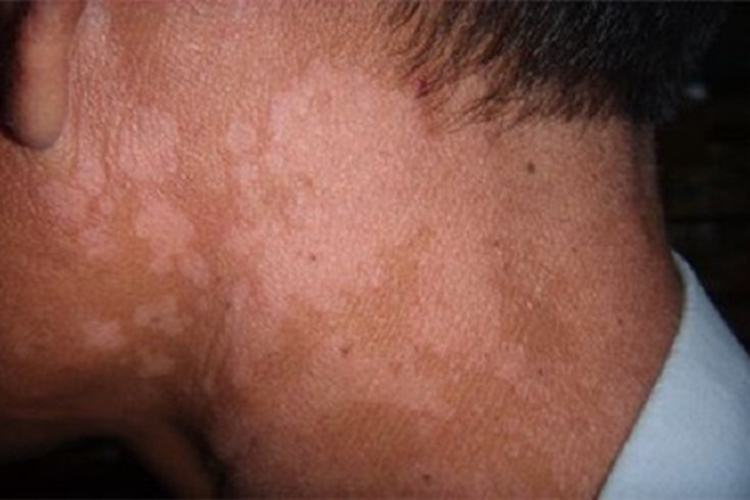 花斑糠疹耳后发白图