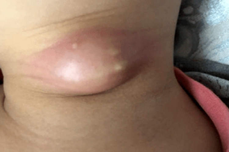 甲状舌管囊肿前颈肿大包图 甲状舌管囊肿前颈肿大包图