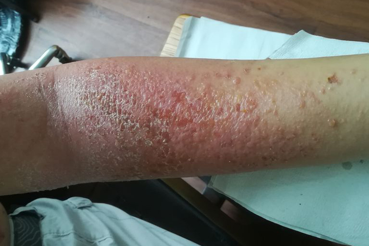 亚急性湿疹手臂红点点图