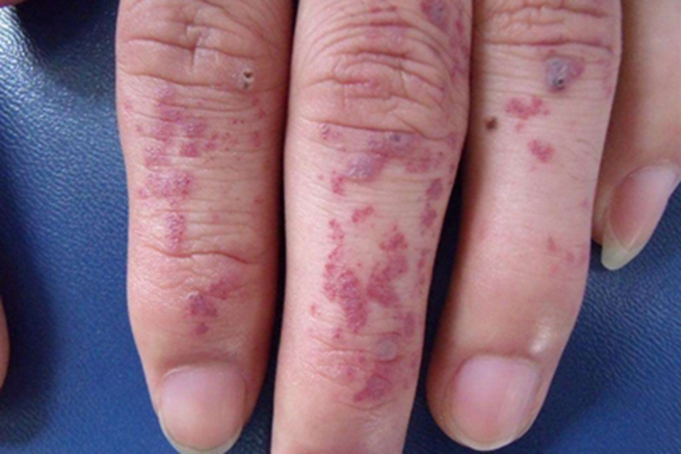 血管角化瘤长红斑图 血管角化瘤长红斑图