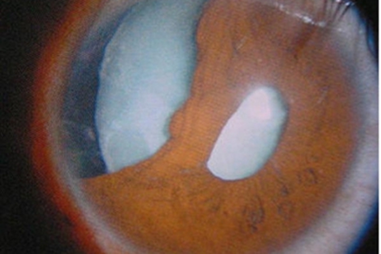 眼部钝挫伤所致白内障症状图 眼部钝挫伤所致白内障症状图