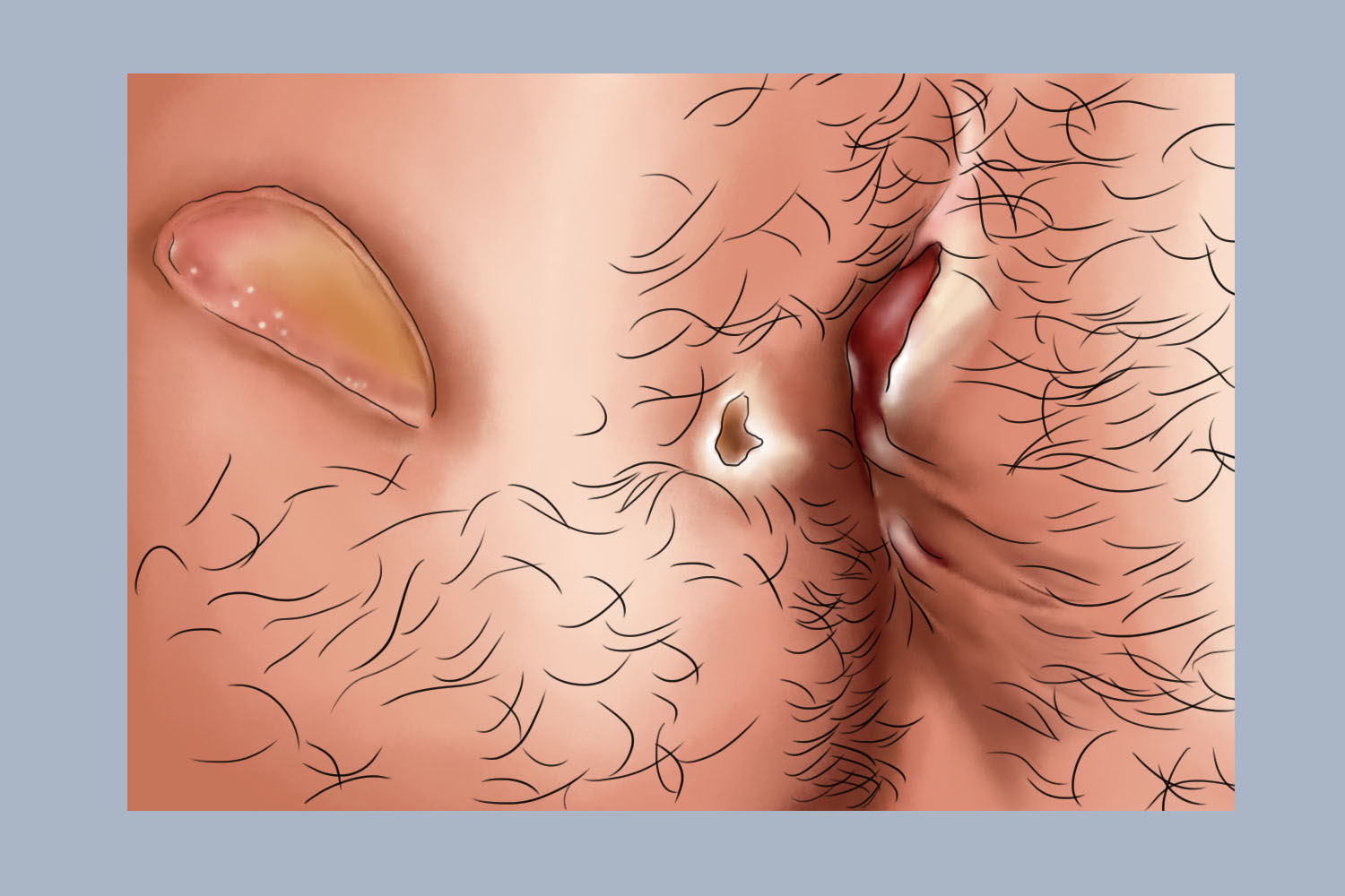 低位肛瘘手术炎症期图