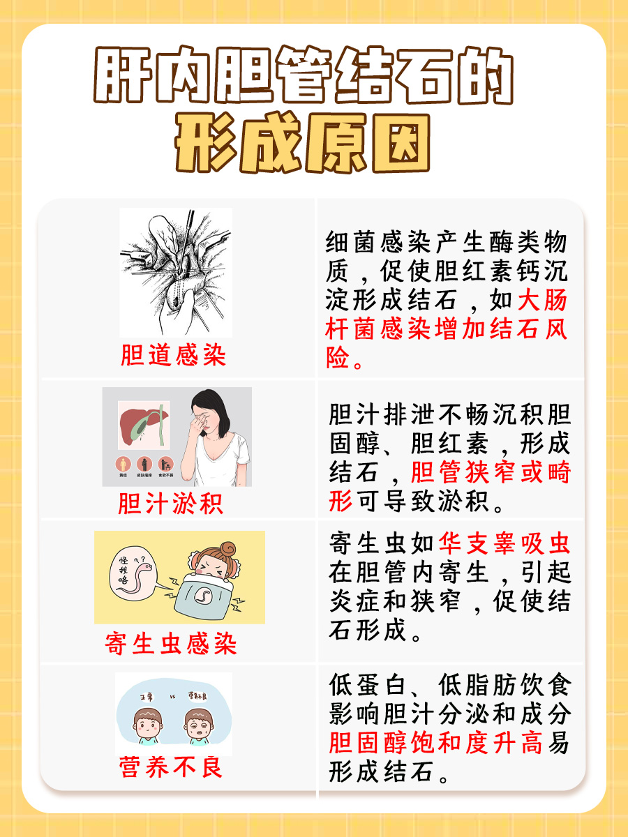 探究：肝内胆管结石是如何形成的？