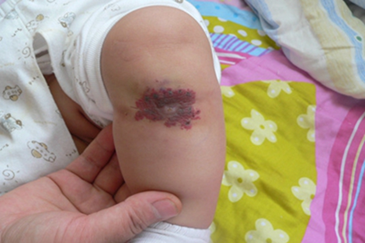 蔓状血管瘤小腿小红疙瘩图