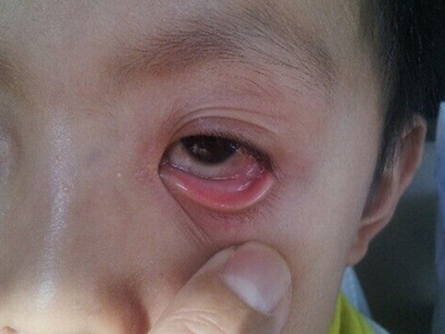 儿童过敏性结膜炎下眼睑发红有红血丝图