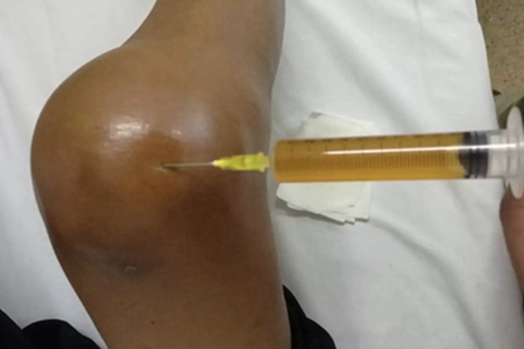 女性二期梅毒膝盖肿图