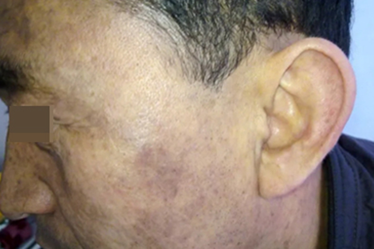 皮肤黑变病左脸有褐色斑块图