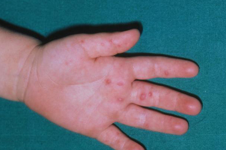 手足口病手部初期丘疹图 手足口病手部初期丘疹图