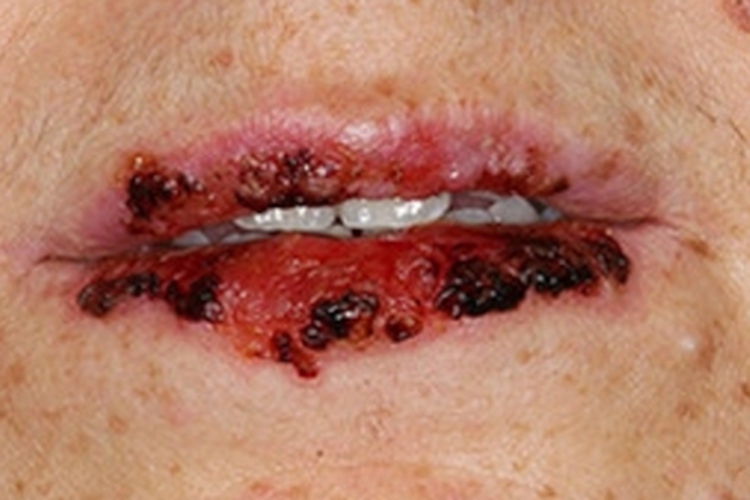 副肿瘤性天疱疮嘴唇黑痂图
